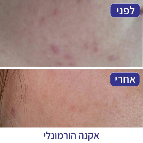 אקנה הורמונלי - חני רוזנברג