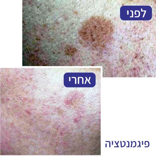 הבהרת פיגמנטציה - חני רוזנברג
