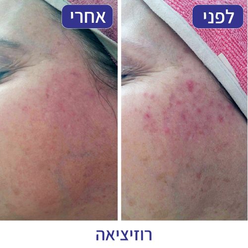 רוזיציאה - חני רוזנברג